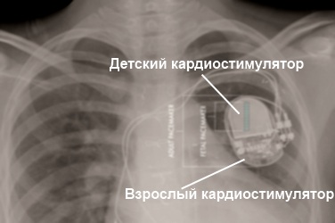 Сравнение взрослого и детского кардиостимулятора
